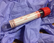 Informations sur le diagnostic en laboratoire de la maladie de Lyme